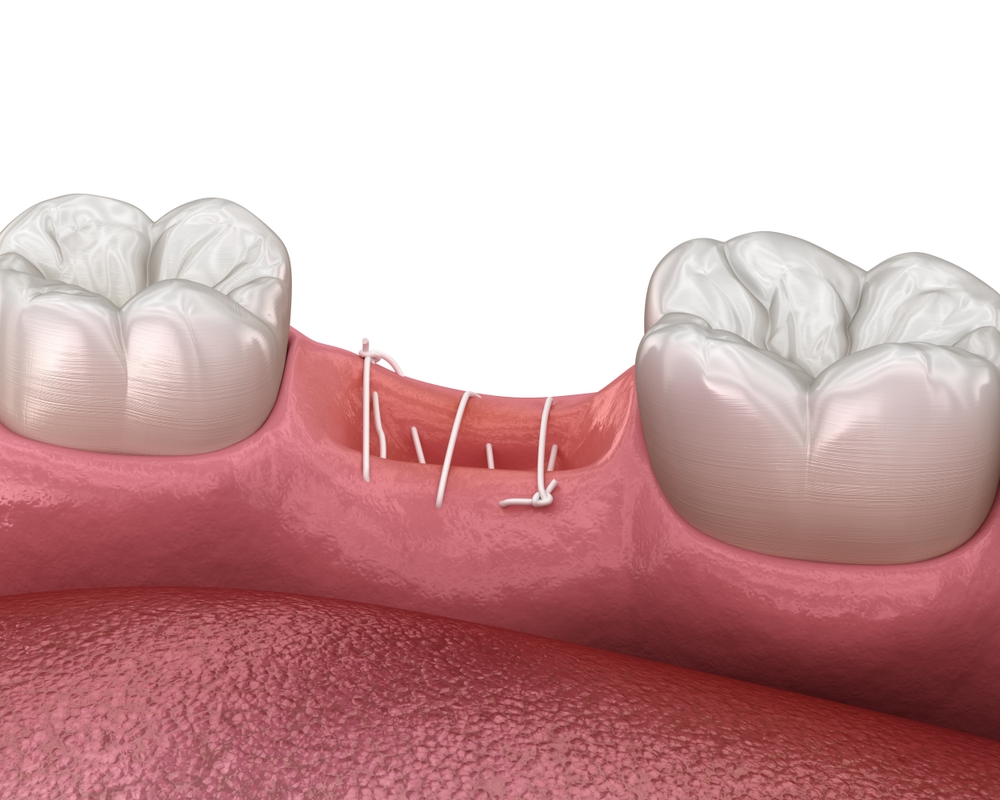 Infografía de una endodoncia