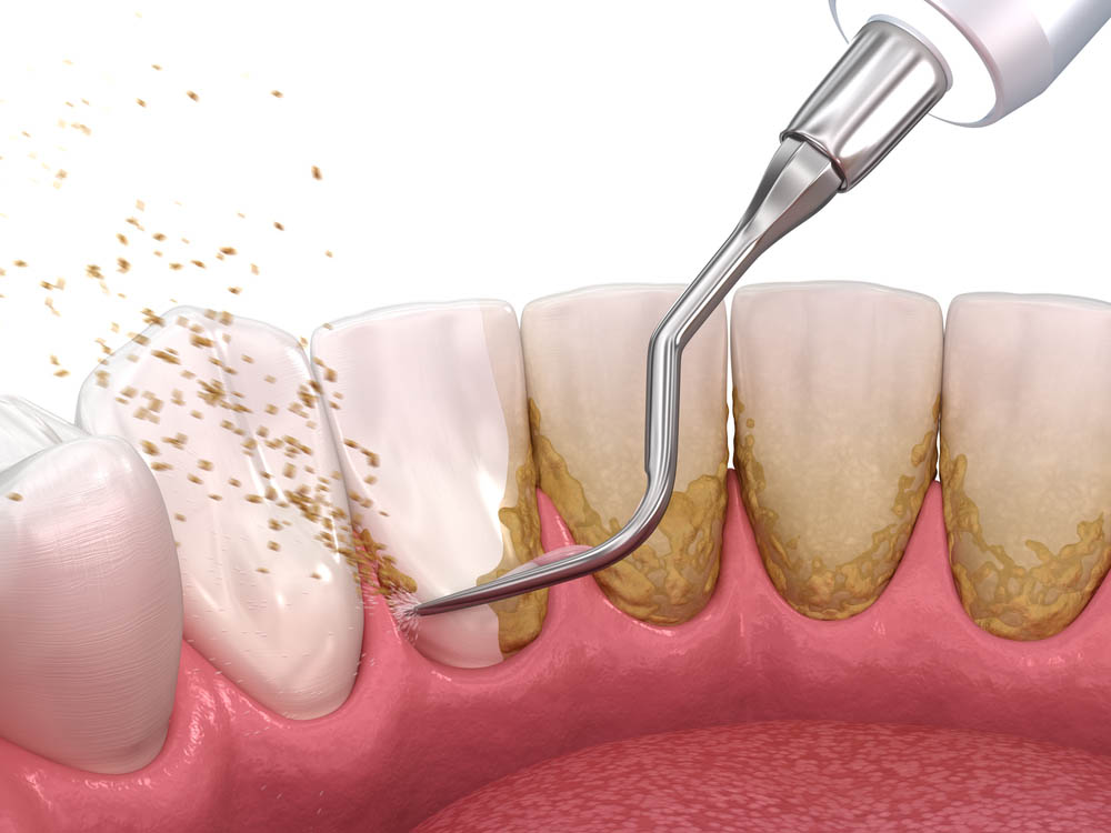 Infografía de limpieza dental