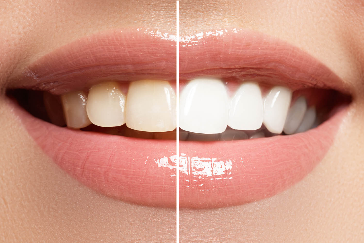 Blanqueamiento dental por Luz Led