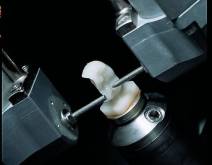 Imágenes de un caso real en clínica dental Padrós con el sistema CEREC CAD-CAM. Con el uso del software de diseño podemos mejorar el diseño y creación de restauraciones dentales, especialmente prótesis dentales incluyendo coronas, carillas, puentes, implantes y aparatos de ortodoncia