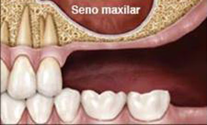 Técnica de Summers para la elevación del seno maxilar