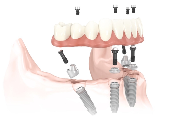 Implantes All on 4