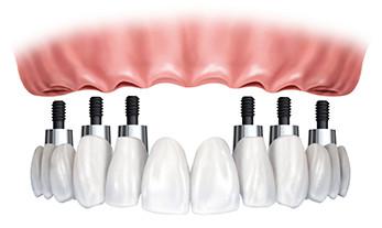 Implantes All on 6